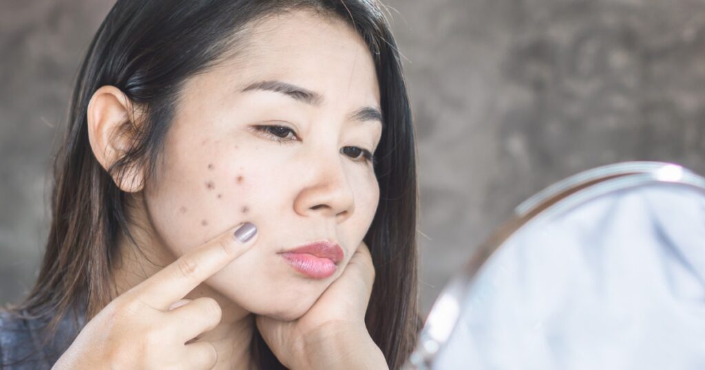 Dark Spots On Face Removal